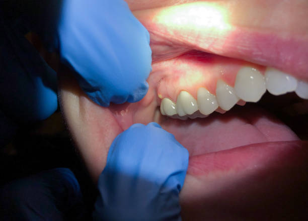 Best Emergency Dental Extractions in Ridgemark, CA